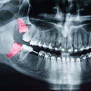 Impacted wisdom teeth can affect the cost of their extraction