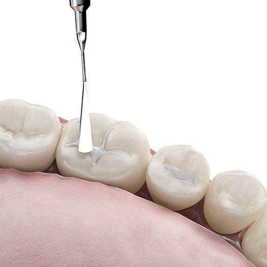 Closeup of device applying dental bonding to enamel