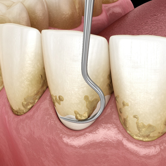 Illustration of scaling and root planing