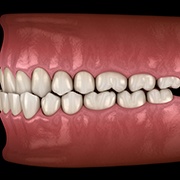 Illustration of an underbite