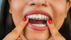 Close up of woman inserting top Invisalign tray